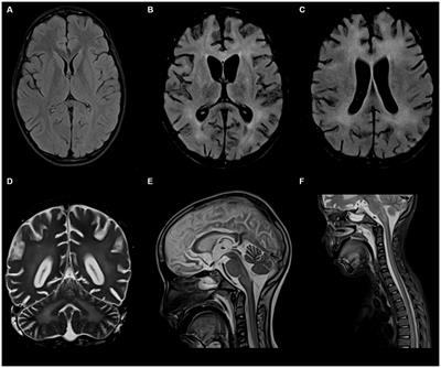 Novel TLR7 hemizygous variant in post-COVID-19 neurological deterioration: a case report with literature review